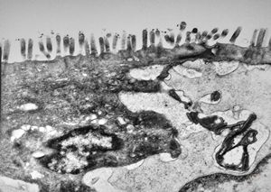 celiakia- lymphocytic invasion celiakia- lymphocytic invasion